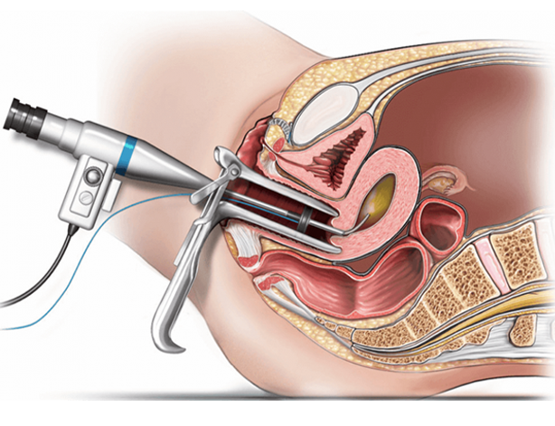 Hysteroscopy